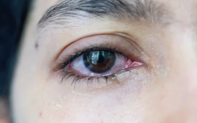 Why Do My Eyes Water Even When They Feel Dry?
