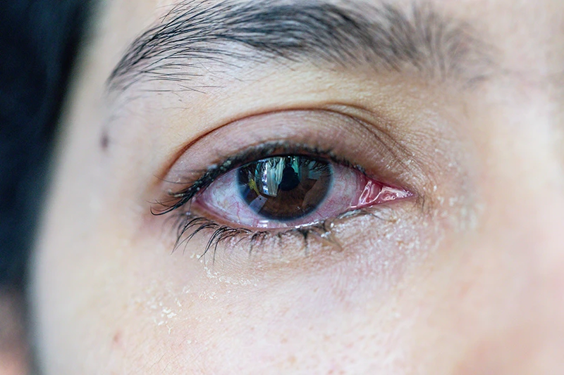 Why Do My Eyes Water Even When They Feel Dry?